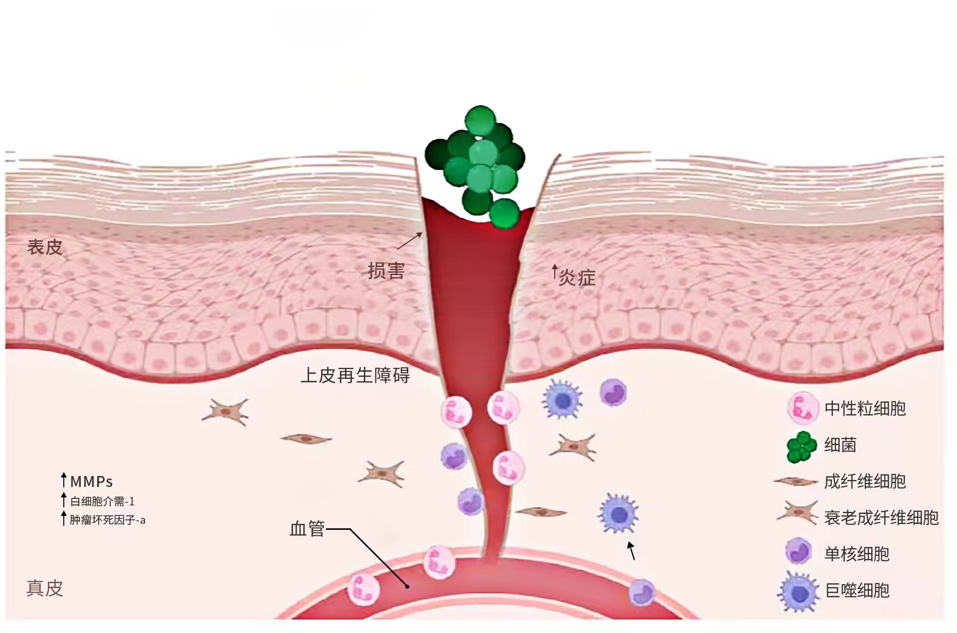 A nurse cleaning an infected wound on a leg